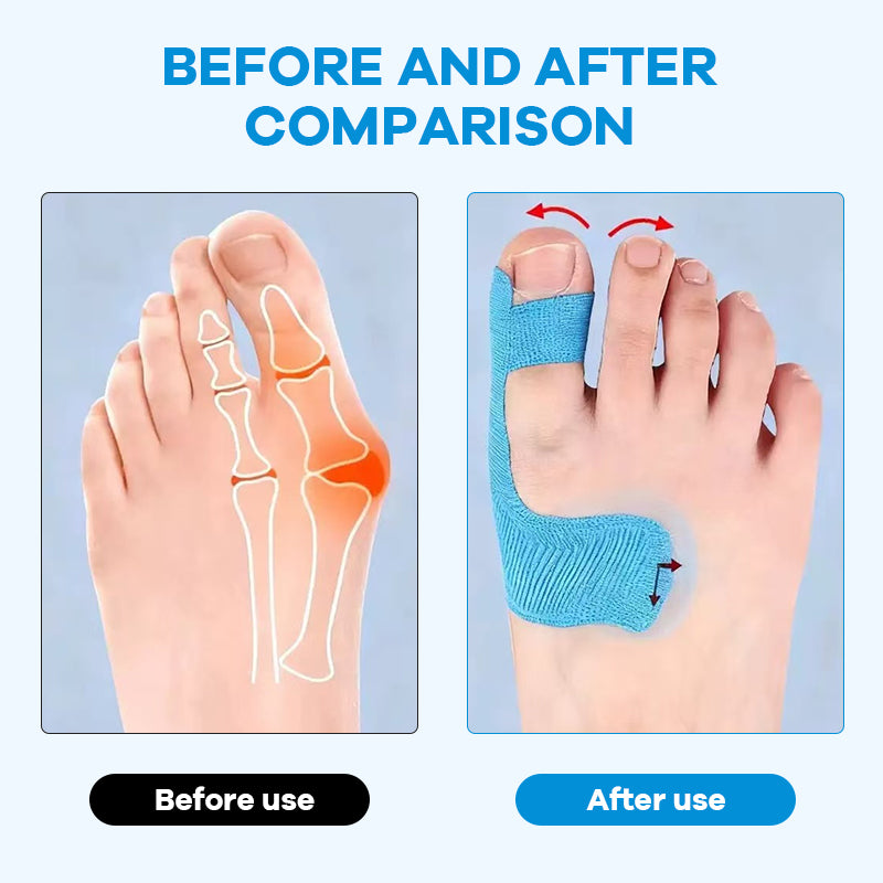 🏆🦶Medical-Grade Bunion Tape – 🦶Hypoallergenic, Breathable, Painless Removal👟